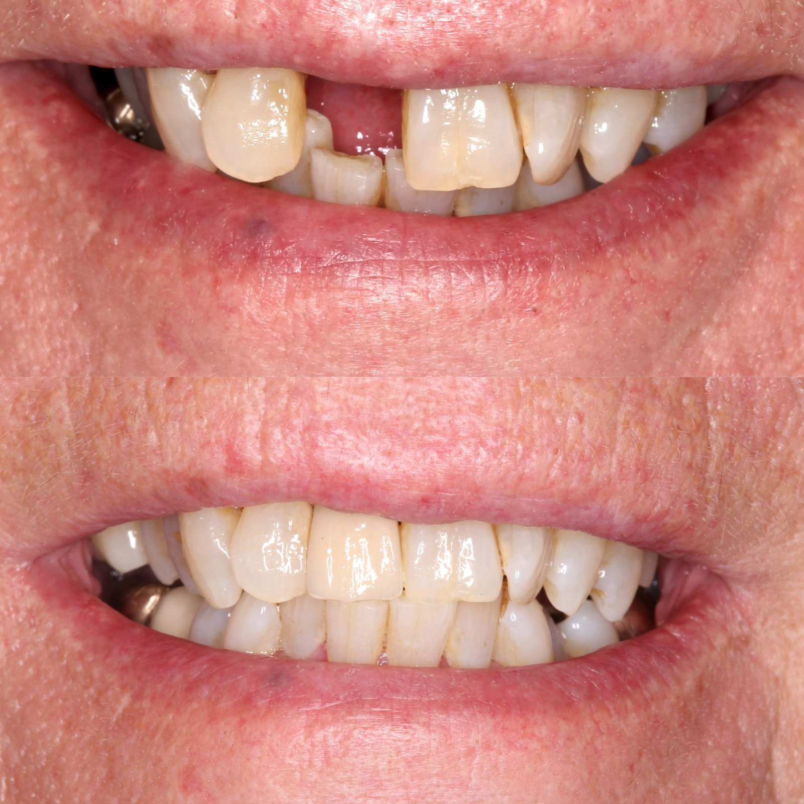 before and after dental implants - landing page