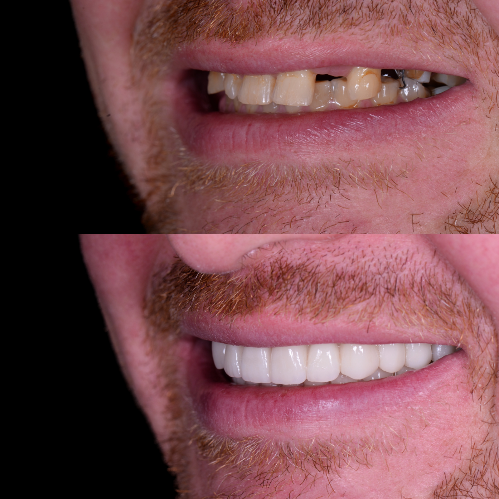 before and after dental implants