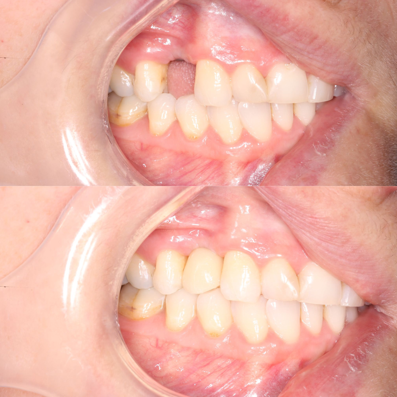 before and after implants - landing page