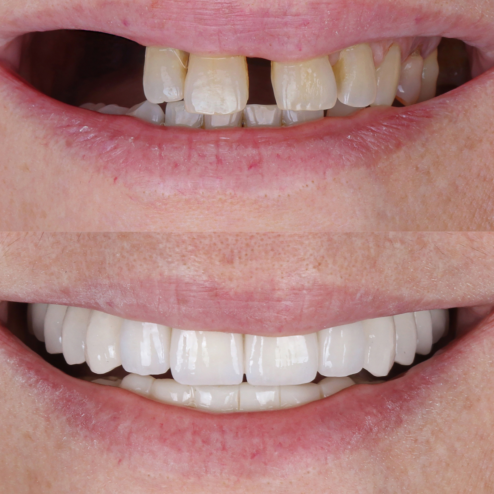 before and after implants
